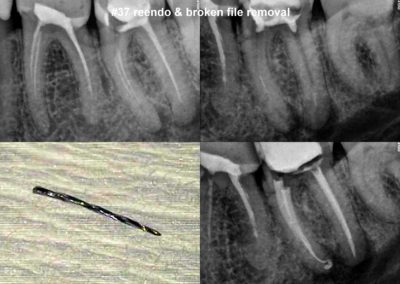 Powtórne leczenie kanałowe pod mikroskopem zęba 37