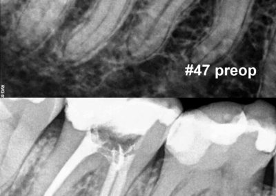Leczenie kanałowe pod mikroskopem zęba 47