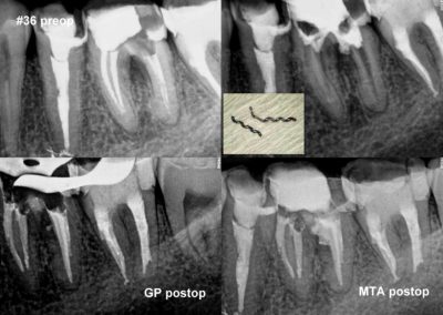 Leczenie kanałowe pod mikroskopem zęba 36