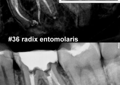 Leczenie kanałowe pod mikroskopem zęba 36