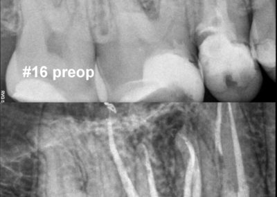 Leczenie kanałowe pod mikroskopem zęba 16