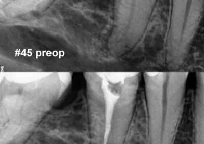 Leczenie kanałowe pod mikroskopem - ząb 45