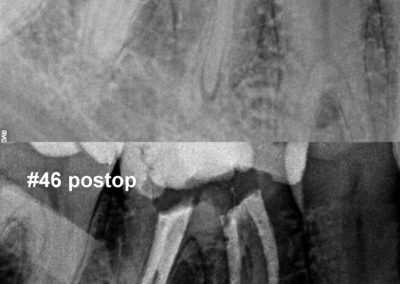 Leczenie kanałowe pod mikroskopem zęba 46