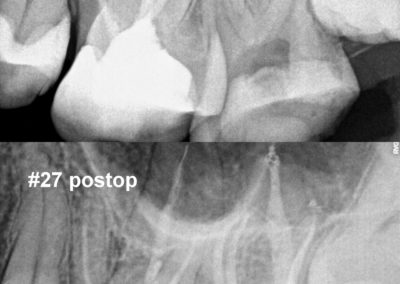 Leczenie kanałowe pod mikroskopem - ząb 27