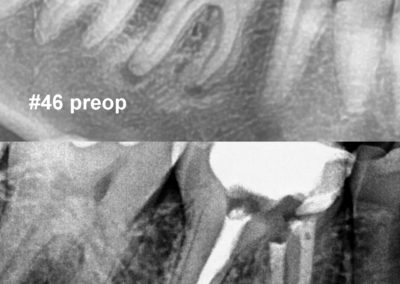 Leczenie kanałowe pod mikroskopem zęba 46