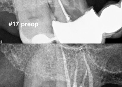 Leczenie kanałowe pod mikroskopem zęba 17