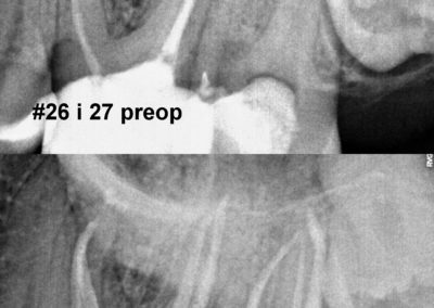 Leczenie kanałowe pod mikroskopem zębów 26 i 27