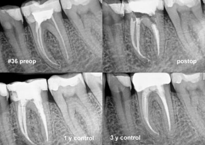 Leczenie kanałowe pod mikroskopem zęba 36