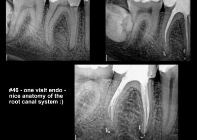 Leczenie kanałowe pod mikroskopem zęba 46