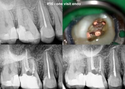 Leczenie kanałowe pod mikroskopem zęba 16