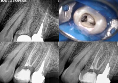 Leczenie kanałowe pod mikroskopem zęba 24