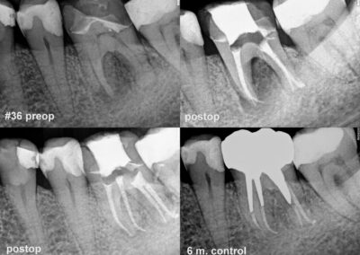 Leczenie kanałowe pod mikroskopem zęba 36