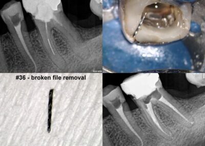 Leczenie kanałowe pod mikroskopem zęba 36