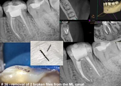 Leczenie kanałowe pod mikroskopem zęba 36