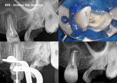 Leczenie kanałowe pod mikroskopem zęba 25