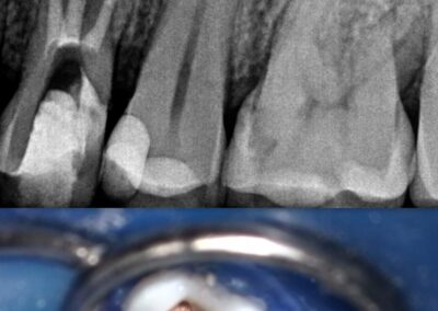 Leczenie kanałowe pod mikroskopem zęba 24