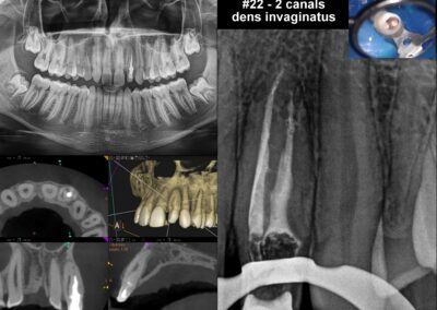 Leczenie kanałowe pod mikroskopem zęba 22 - ząb wgłobiony