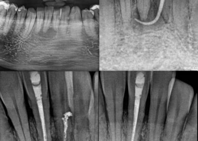 Leczenie kanałowe pod mikroskopem zęba 41